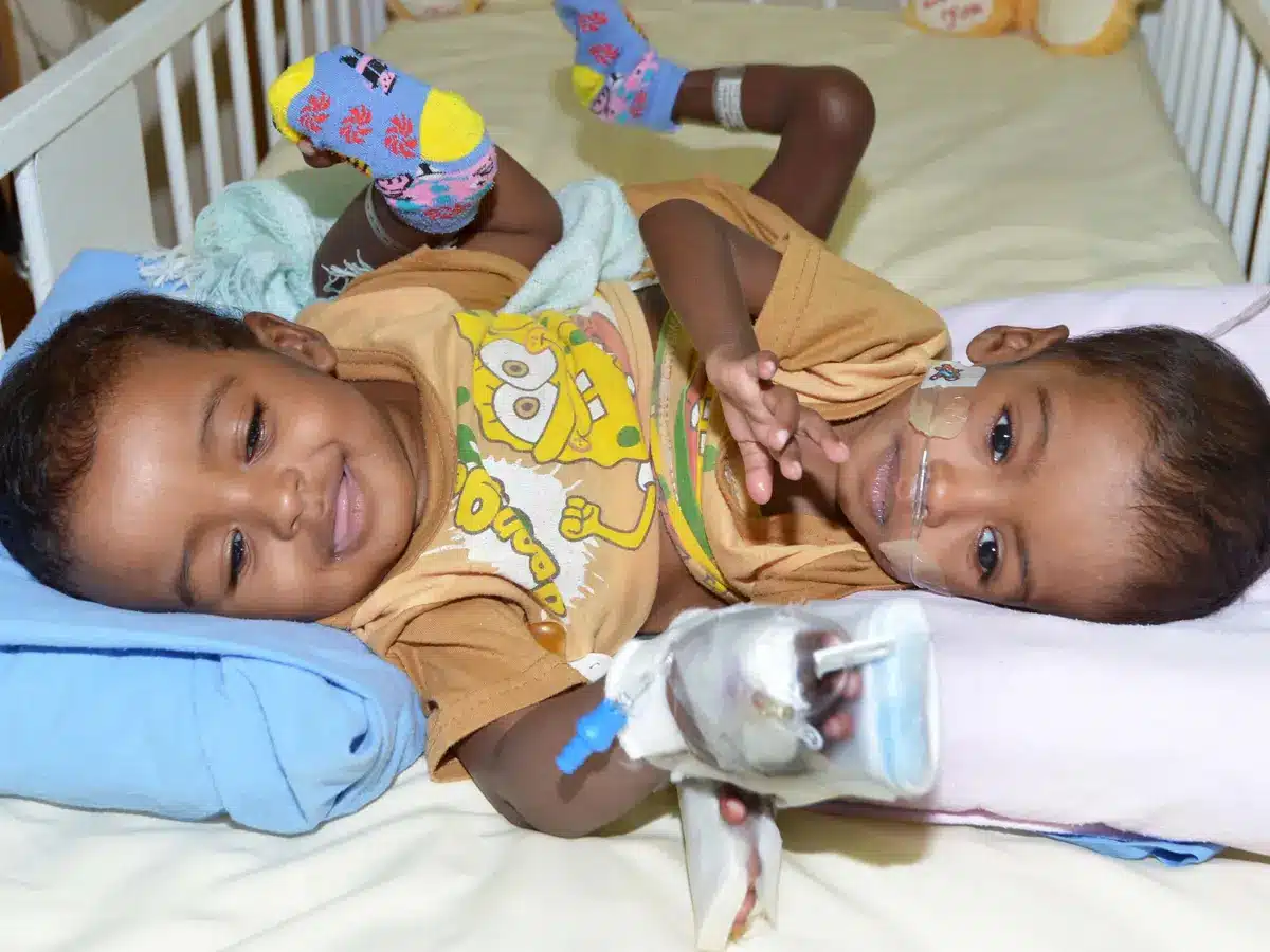 عملية فصل توأم سيامي في ود مدني تحقق المعجزة الطبية في السودان020 عملية فصل توأم سيامي في ود مدني تحقق المعجزة الطبية في السودان