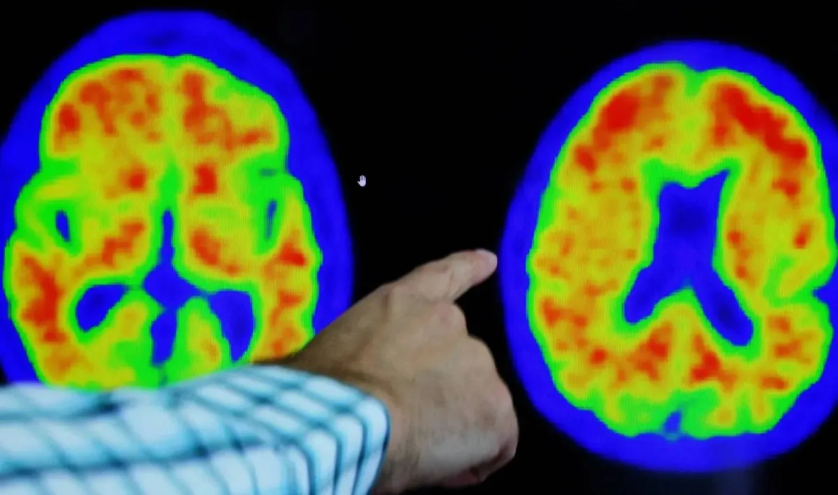 من بينها الفياغرا... 5 أدوية ولقاحات لها تأثيرات مفاجئة للوقاية من ألزهايمر020 من بينها الفياغرا... 5 أدوية ولقاحات لها تأثيرات مفاجئة للوقاية من ألزهايمر