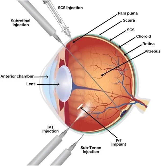 تقنيات حديثة لحقن الأدوية في شبكية العين